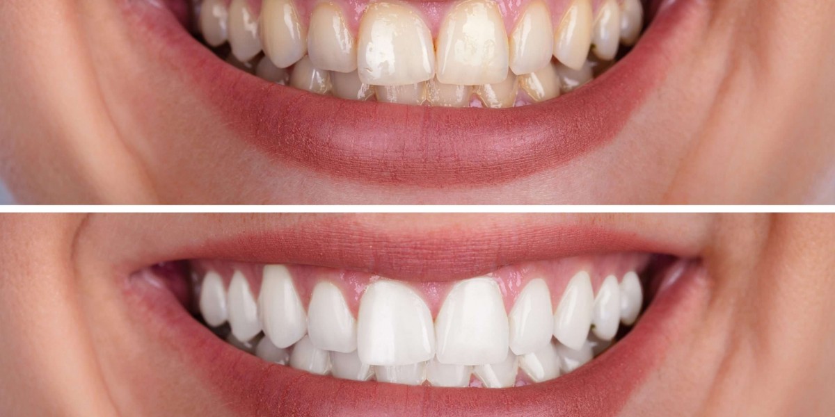The Role of Fluoride in Whitening Maintenance