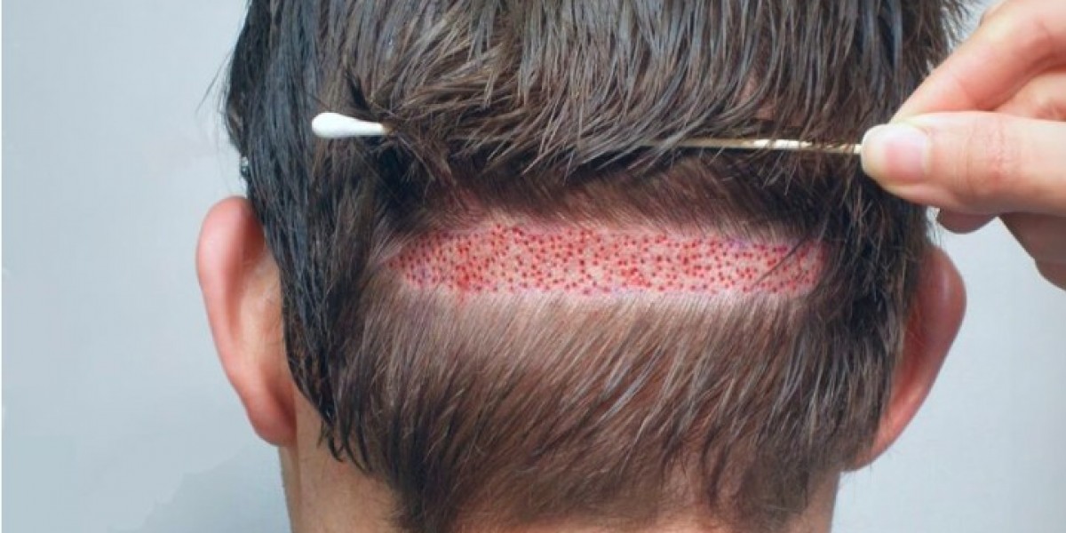 Celebrity Hair Transplants in Pakistan: Who Got It Done?