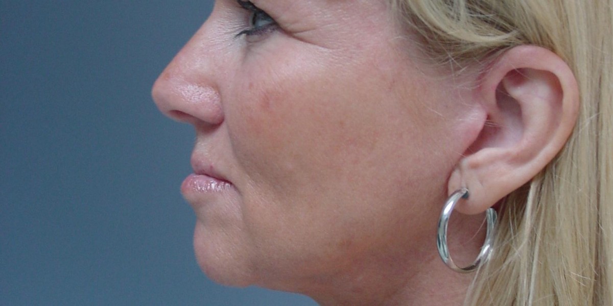 Plastic and Reconstructive Surgery Abu Dhabi Orthognathic Surgery